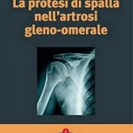 La Protesi di Spalla nell'artrosi gleno-omerale (trovasi anche la versione inglese)