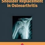 Shoulder Replacement in Osteoarthritis (trovasi anche la versione italiana)
